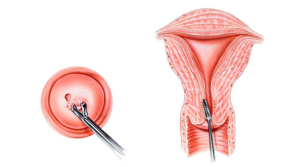 Biopsia de cervix